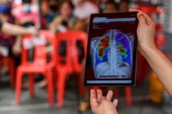 Un nouveau traitement redonne espoir dans la lutte contre la tuberculose en Asie